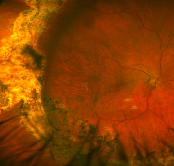 repairing a detached retina