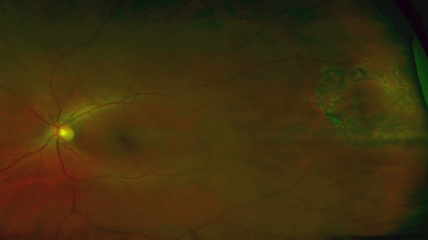 Retinal Tear - Associated Retinal Consultants P.C.