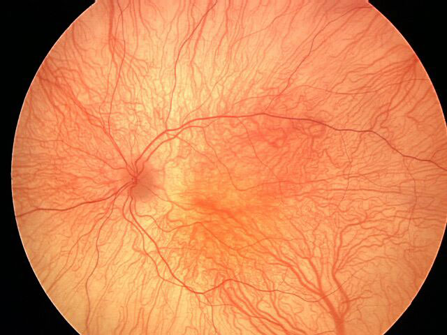associated retina consultants ltd